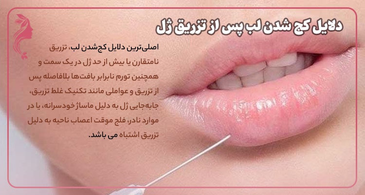 دلایل کج شدن لب پس از تزریق ژل لب